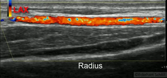 Arteria radialis längs und quer