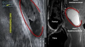 Baker-Zyste