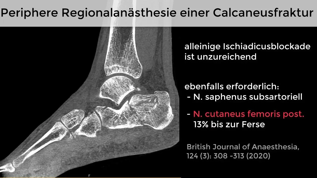 Blockade des Nervus cutaneus femoris posterior