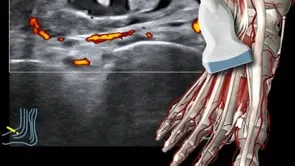 Punktion einer Tendovaginitis des Mittelfußes
